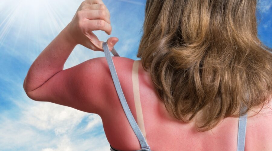 verbrand door de zon