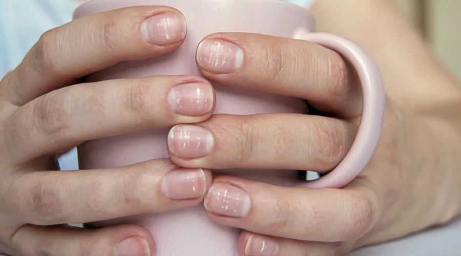 witte vlekjes op nagels
